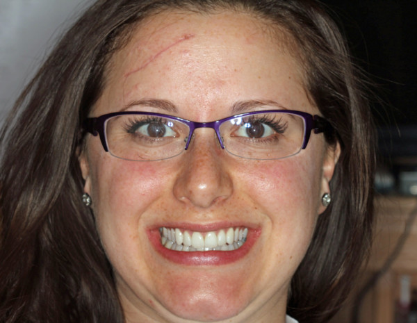 Porcelain veneers restored Erica's smile after an auto accident