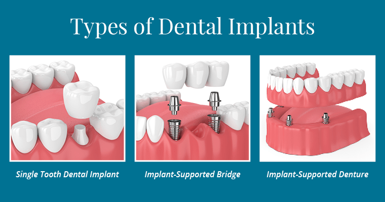The types of dental implants; a single tooth implant, an implant-supported bridge, and a implant-supported denture.